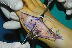 تقنية القطع العظمي