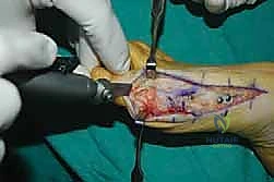 الترقيع العظمي