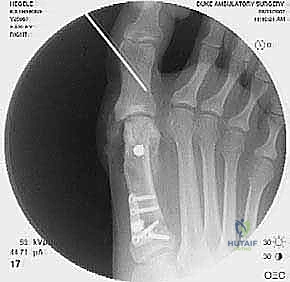 إيثاق مفصل المشط السلامي