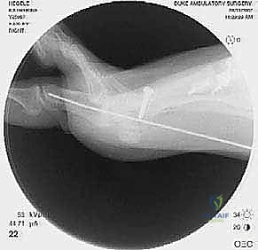 جراحة مراجعة إبهام القدم الأروح: دليل شامل للمرضى مع الأستاذ الدكتور محمد هطيف
