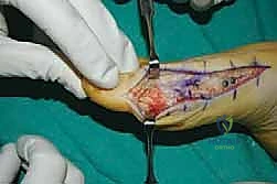 استعادة طول العظم