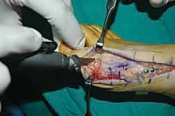 تثبيت المفصل بشريحة