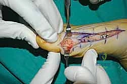 خياطة الجرح التجميلية