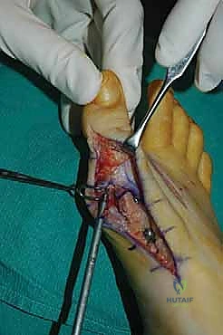 صورة توضيحية لـ جراحة مراجعة إبهام القدم الأروح: دليل شامل للمرضى مع الأستاذ الدكتور محمد هطيف