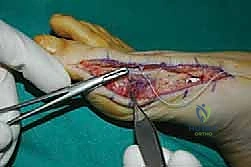 صورة توضيحية لـ جراحة مراجعة إبهام القدم الأروح: دليل شامل للمرضى مع الأستاذ الدكتور محمد هطيف