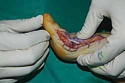 صورة توضيحية لـ جراحة مراجعة إبهام القدم الأروح: دليل شامل للمرضى مع الأستاذ الدكتور محمد هطيف