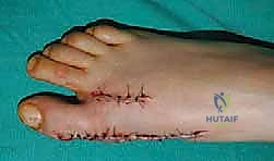 صورة توضيحية لـ جراحة مراجعة إبهام القدم الأروح: دليل شامل للمرضى مع الأستاذ الدكتور محمد هطيف