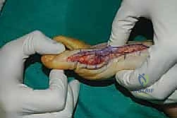 صورة توضيحية لـ جراحة مراجعة إبهام القدم الأروح: دليل شامل للمرضى مع الأستاذ الدكتور محمد هطيف