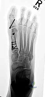 صورة توضيحية لـ جراحة مراجعة إبهام القدم الأروح: دليل شامل للمرضى مع الأستاذ الدكتور محمد هطيف