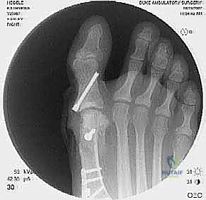 صورة توضيحية لـ جراحة مراجعة إبهام القدم الأروح: دليل شامل للمرضى مع الأستاذ الدكتور محمد هطيف