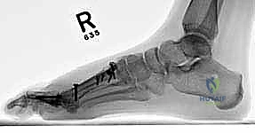 صورة طبية: جراحة مراجعة إبهام القدم الأروح: دليل شامل للمرضى مع الأستاذ الدكتور محمد هطيف