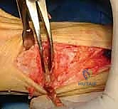 صورة طبية: جراحة مراجعة إبهام القدم الأروح: دليل شامل للمرضى مع الأستاذ الدكتور محمد هطيف