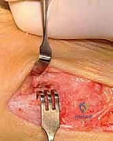 صورة طبية: جراحة مراجعة إبهام القدم الأروح: دليل شامل للمرضى مع الأستاذ الدكتور محمد هطيف