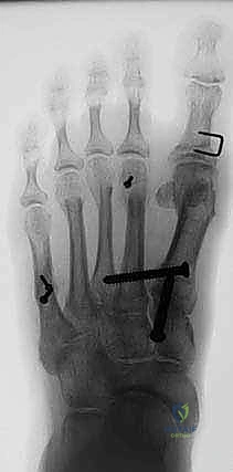 صورة طبية: جراحة مراجعة إبهام القدم الأروح: دليل شامل للمرضى مع الأستاذ الدكتور محمد هطيف