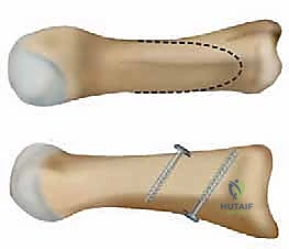 صورة طبية: جراحة مراجعة إبهام القدم الأروح: دليل شامل للمرضى مع الأستاذ الدكتور محمد هطيف