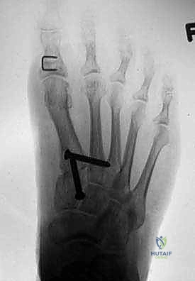 صورة طبية: جراحة مراجعة إبهام القدم الأروح: دليل شامل للمرضى مع الأستاذ الدكتور محمد هطيف