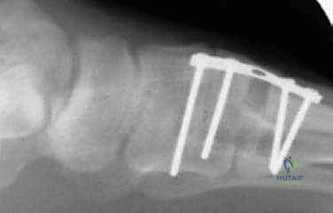 صورة طبية: جراحة مراجعة إبهام القدم الأروح: دليل شامل للمرضى مع الأستاذ الدكتور محمد هطيف