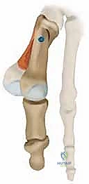 صورة طبية: جراحة مراجعة إبهام القدم الأروح: دليل شامل للمرضى مع الأستاذ الدكتور محمد هطيف