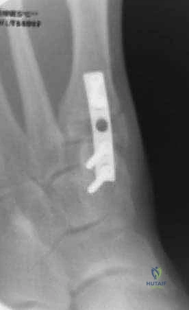 صورة طبية: جراحة مراجعة إبهام القدم الأروح: دليل شامل للمرضى مع الأستاذ الدكتور محمد هطيف