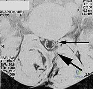 إدخال الأقفاص من الجانبين في PLIF