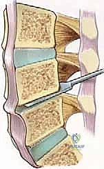 صورة طبية: دمج الفقرات القطنية: تقنيات PLIF و TLIF المتطورة لإنهاء آلام الظهر