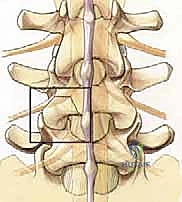 صورة طبية: دمج الفقرات القطنية: تقنيات PLIF و TLIF المتطورة لإنهاء آلام الظهر