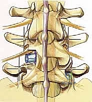 صورة توضيحية لـ دمج الفقرات القطنية: تقنيات PLIF و TLIF المتطورة لإنهاء آلام الظهر
