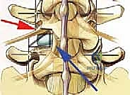 تآكل الغضاريف والانزلاق الفقري