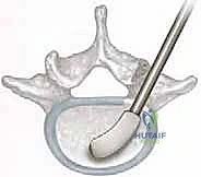 Intraoperative Surgical Step