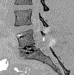 صورة توضيحية لـ دمج الفقرات القطنية: تقنيات PLIF و TLIF المتطورة لإنهاء آلام الظهر