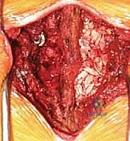 صورة توضيحية لـ دمج الفقرات القطنية: تقنيات PLIF و TLIF المتطورة لإنهاء آلام الظهر