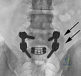 صورة طبية: دمج الفقرات القطنية: تقنيات PLIF و TLIF المتطورة لإنهاء آلام الظهر