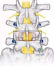 صورة توضيحية لـ دمج الفقرات القطنية: تقنيات PLIF و TLIF المتطورة لإنهاء آلام الظهر