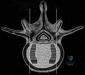 Mastering Lumbar Interbody Fusion: TLIF & PLIF Techniques