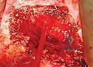 التعافي وإعادة التأهيل بعد جراحة العمود الفقري