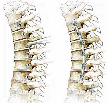 Illustration of anterior thoracic corpectomy - Dr. Mohammed Hutaif