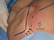 التشريح المعقد للمفصل الكتفي الصدري والجرابات الزلالية