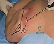 استئصال الجراب الملتهب باستخدام أدوات المنظار الدقيقة