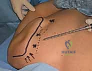 صورة توضيحية لـ جراحة تخفيف الضغط الكتفي الصدري بالمنظار: حل نهائي لمتلازمة الكتف الطاقطاقة