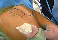 Arthroscopic Scapulothoracic Decompression: A Masterclass for Fellows