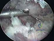 صورة توضيحية لـ جراحة تخفيف الضغط الكتفي الصدري بالمنظار: حل نهائي لمتلازمة الكتف الطاقطاقة