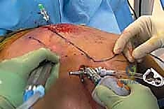 إنشاء المداخل الجراحية الدقيقة بالمنظار