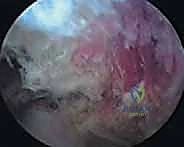 صورة توضيحية لـ جراحة تخفيف الضغط الكتفي الصدري بالمنظار: حل نهائي لمتلازمة الكتف الطاقطاقة