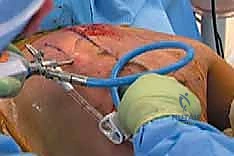 التصوير الطبي المتقدم لتشخيص متلازمة الكتف الطاقطاقة