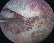 جراحة تخفيف الضغط الكتفي الصدري بالمنظار: حل نهائي لمتلازمة الكتف الطاقطاقة