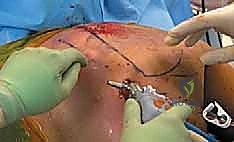 الحقن الموضعي والعلاج التحفظي لمتلازمة الكتف الطاقطاقة