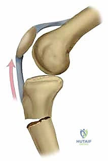صورة توضيحية لـ التسمير النخاعي لكسور عظم الساق (الظنبوب): دليل شامل للمرضى مع الأستاذ الدكتور محمد هطيف