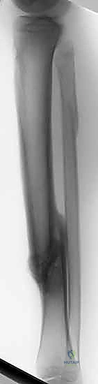 صورة طبية: التسمير النخاعي لكسور عظم الساق (الظنبوب): دليل شامل للمرضى مع الأستاذ الدكتور محمد هطيف