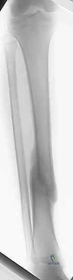 إدخال السلك الدليلي