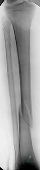 أهمية العلاج الطبيعي بعد جراحة العظام